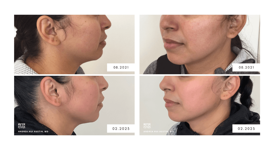 Buccal Fat Removal